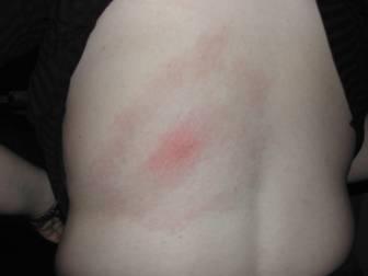 Figure 1. Typical erythema migrans lesion