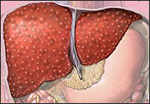liver with cirrhosis