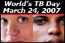 Tuberculosis is Preventable and Curable. Get Tested.