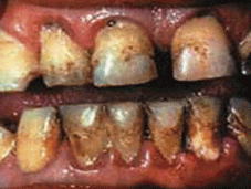 pr017-07-decaying-teeth.gif