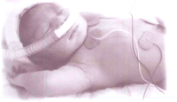 Premature infant in Neonatal Intensive Care Unit