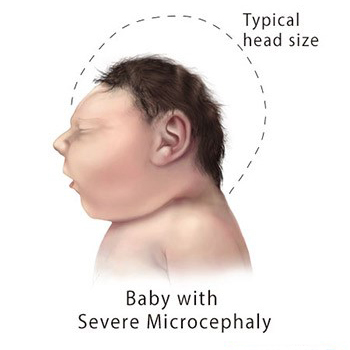 severe microcephaly