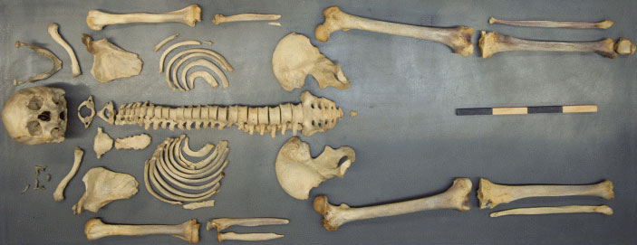 skeleton on an exam table