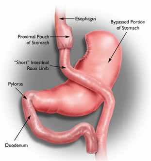gastricbypass
