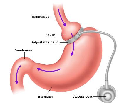 lapband